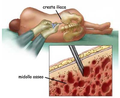 donazione midollo osseo